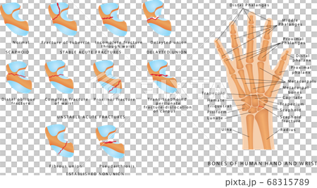 Wrist fracture (Scaphoid) - Stock Illustration [68315789] - PIXTA