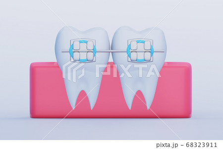 Two Teeth with Metal Braces, molars in the gums Two Teeth with Metal Braces, molars in the gums 68323911