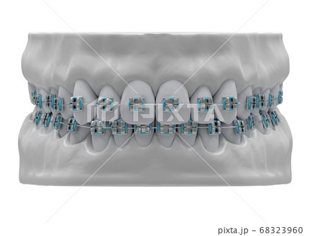 Human jaws with healthy teeth and classic metal 68323960