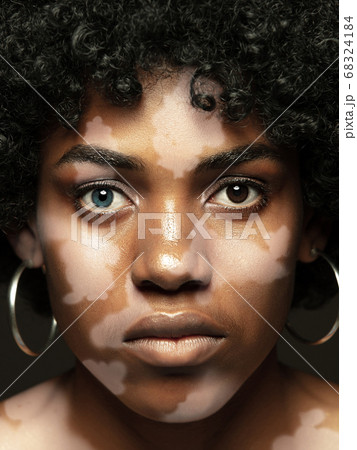 Studio portrait of african-american woman with vitiligo skin, beauty concept 68324184
