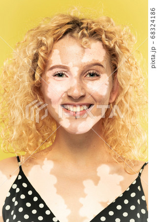 Studio portrait of caucasian woman with vitiligo skin, beauty concept 68324186