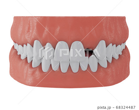 jaw with missing front tooth deuce on white 68324487