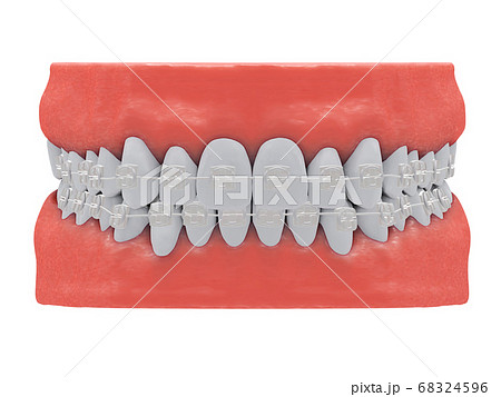 invisible braces 68324596