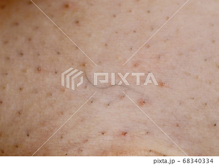 埋没毛　埋もれ毛 68340334