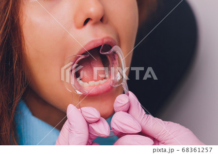 Close-up portrait of a female patient visiting dentist for teeth whitening in clinic,Teeth whitening procedure. 68361257