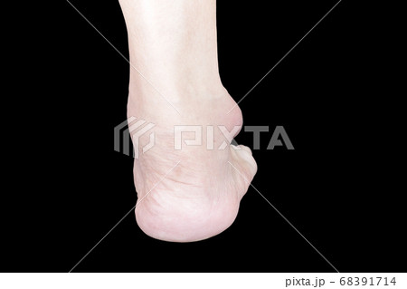 Astragalus is swollen Astragalus is swollen 68391714