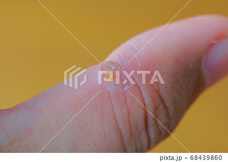 傷口が化膿した重度のアレルギー患者の手と指の写真素材