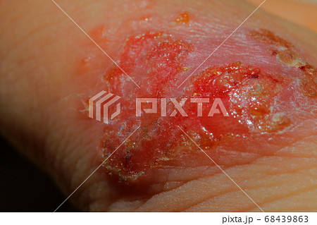 傷口が化膿した重度のアレルギー患者の皮膚細胞の写真素材