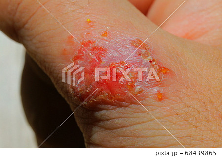 傷口が化膿した重度のアレルギー患者の皮膚細胞の写真素材