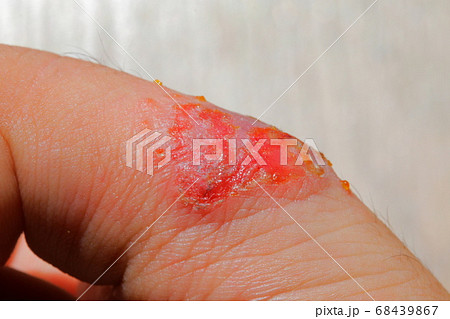 傷口が化膿した重度のアレルギー患者のとびひした皮膚細胞の写真素材