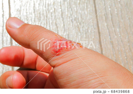傷口が化膿した重度のアレルギー患者の皮膚細胞 68439868