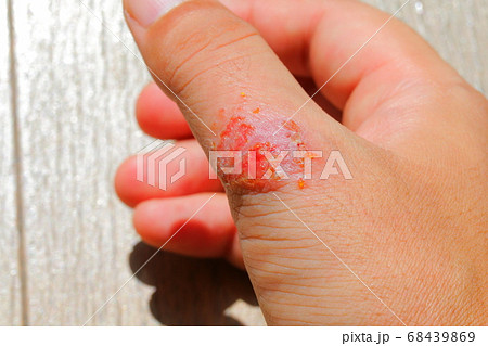 傷口が化膿した重度のアレルギー患者の血が出た皮膚細胞の写真素材