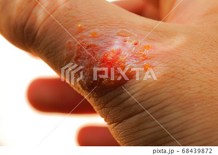 傷口が化膿した重度のアレルギー患者の血が出た皮膚細胞の写真素材