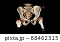 Computed Tomography Volume Rendering examination of the  pelvis showing left femur neck fracture ( CT VR Pelvis).Radiology examination 68462315