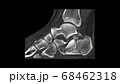 Computed Tomography  of the  foot in sagittal plane showing fracture of  calcaneum/ heel bone ( CT Foot).Radiology examination 68462318