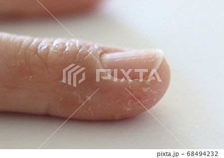 汗疱 汗疱 68494232