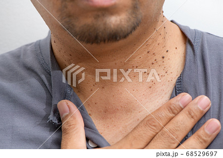 Closed up the Skin Tags or Acrochordon on neck man Closed up the Skin Tags or Acrochordon on neck man 68529697