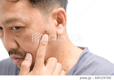 Middle-aged asian man worry about big skin tags or 68529700