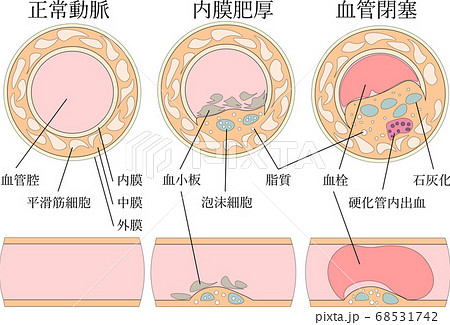 血管閉塞 68531742