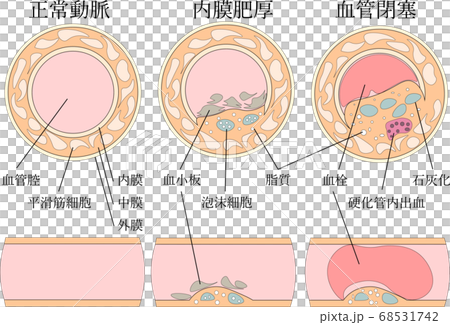 血管閉塞 68531742