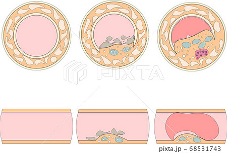 血管閉塞 68531743
