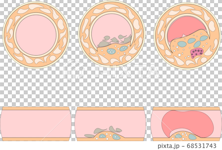 血管閉塞 68531743