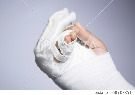 手の骨折 手の骨折 68587851
