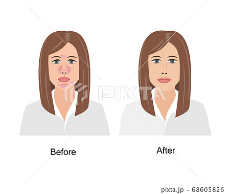 Woman Suffering from Seborrheic Dermatitis before and after medical treatment. Vector illustration. Adult or teenager face with skin problems isolated white background 68605826