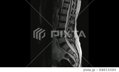 Magnetic Resonance images of Lumbar spine sagittal T2-weighted images (MRI Lumbar spine) showing mild disc disease. Magnetic Resonance images of Lumbar spine sagittal T2-weighted images (MRI Lumbar spine) showing mild disc disease. 68653494