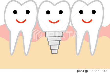 インプラントのイラストのイラスト素材