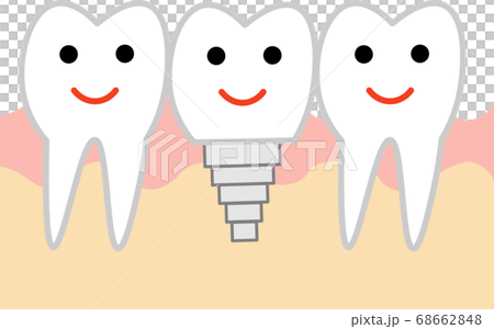 インプラントのイラストのイラスト素材
