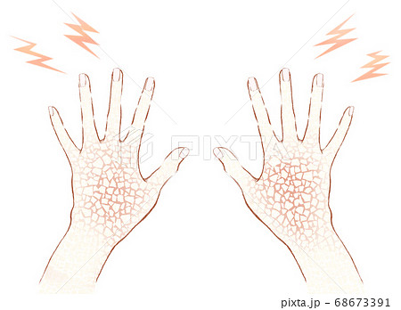 手の甲のひび割れ　手荒れ 68673391