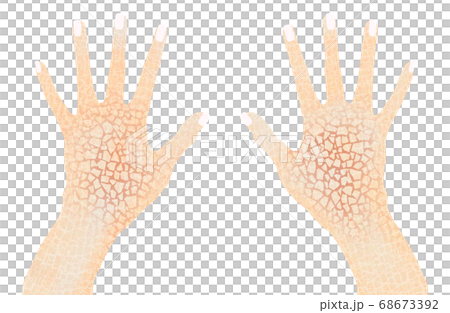 ひどい手荒れ　ヒビ割れ　乾燥した手 68673392