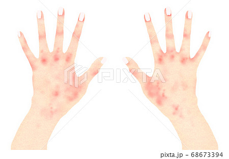 かゆい 手の甲 が 手の甲に赤い斑点ができてブツブツしてかゆい時と痒くない時の違いは？