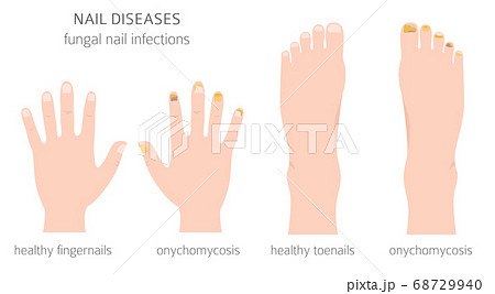 Nail diseases. Onychomycosis, nail fungal 68729940