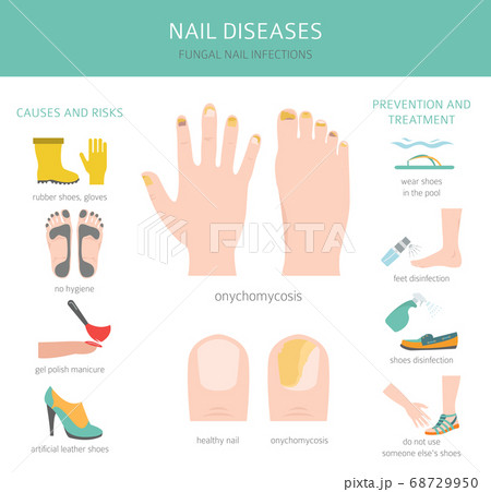 Nail diseases. Onychomycosis, nail fungal 68729950