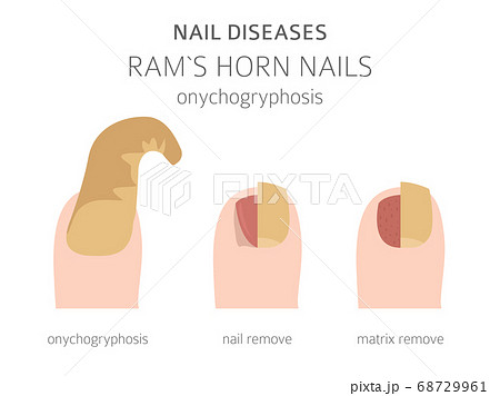 Dr. Seema Zia - Nails are just as important part of your body as another!  Different infections cause different discomforts. This chart explains  various nail diseases that are harmful if not treated