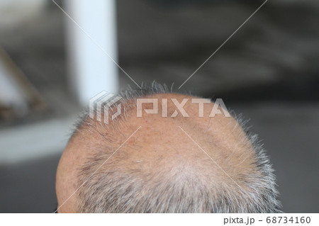 後ろ禿げ 後ろ禿げ 68734160