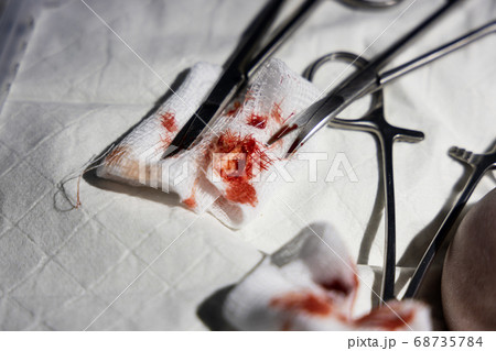 Extracted ingrown toenail with blood on gauze 68735784