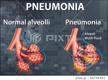 Comparison of healthy alveoli and Pneumonia 68746891