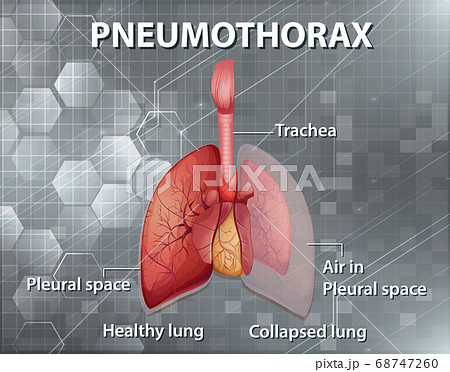 Informative illustration of Pneumothorax 68747260