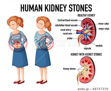 Comparison of healthy kidney and kidney with Comparison of healthy kidney and kidney with 68747359