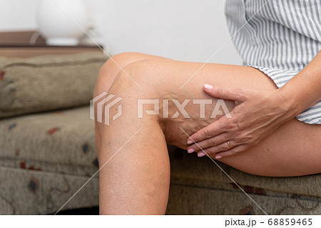 Woman at home with varicose veins. Healthcare problem, thrombophlebitis issue. 68859465