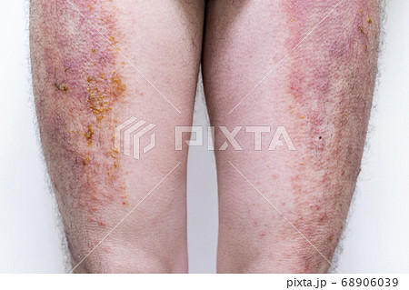 膿の出ている重度の湿疹 68906039