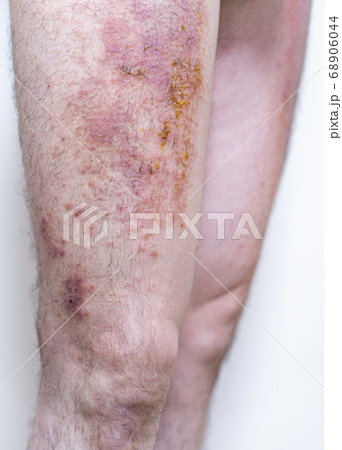 膿の出ている重度の湿疹の写真素材