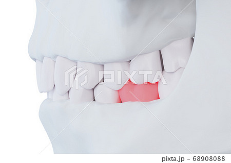 human jaw with a sore tooth, red lower sixth molar 68908088