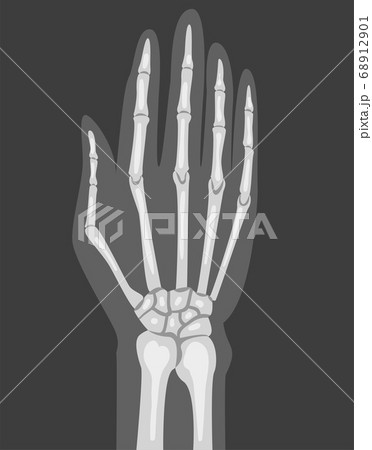 X-ray Film of Hand Vector Illustrated Image for Educational Purpose 68912901