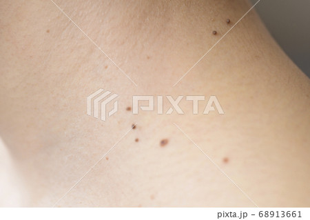老人性疣　イボ　疣　皮膚　加齢　美容　肌　女性　人物　ボディパーツ 68913661