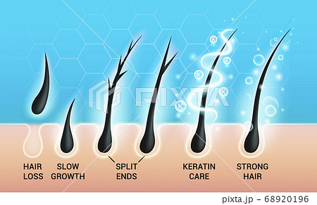 Different hair problems and deep salon treatment vector illustrations set, macro view of balding scalp skin and follicles Different hair problems and deep salon treatment vector illustrations set, macro view of balding scalp skin and follicles 68920196