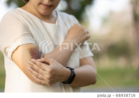 Sad asian female people showing a bruise in her arm,woman has bruises all over her body,caused by the abuse of a family or her husband violently attacked,being hit by a hard,bashing causes bruising 68938716